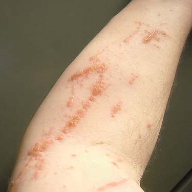 skin rash after contact with poison oak at Klickitat (River) Trail near Pitt, Klickitat County, Washington